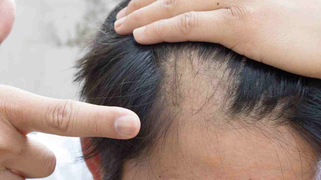 cura contro alopecia areata